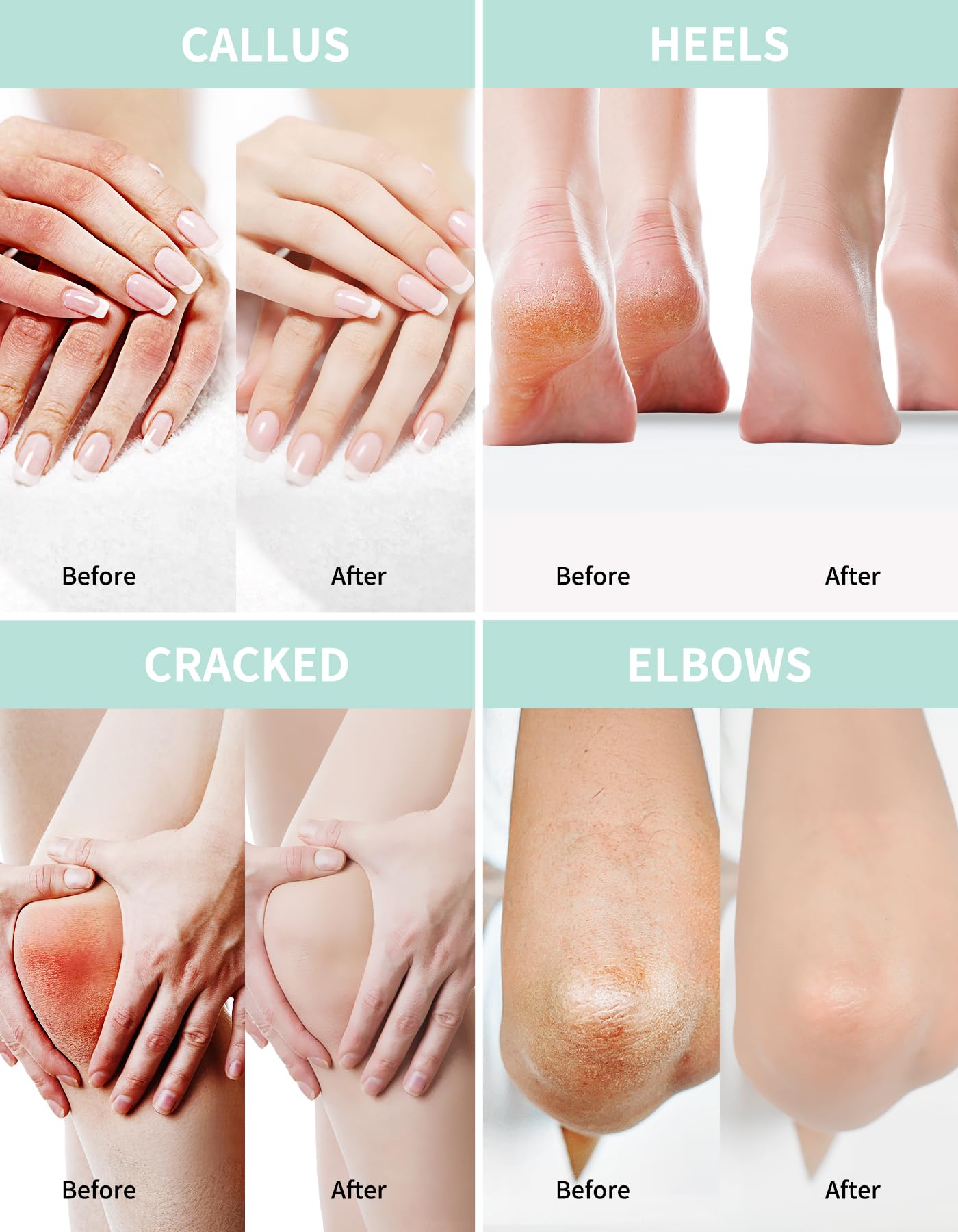 Urea Cream 20 Percent For Feet Plus 2% Salicylic Acid 150g || Foot Cream and Hand Cream Maximum Strength with Hyaluronic Acid, Tea Tree, and Aloe Vera for Deep Moisturizes