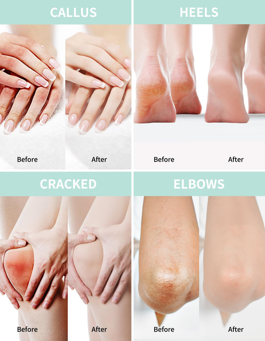 Urea Cream 20 Percent For Feet Plus 2% Salicylic Acid 150g || Foot Cream and Hand Cream Maximum Strength with Hyaluronic Acid, Tea Tree, and Aloe Vera for Deep Moisturizes