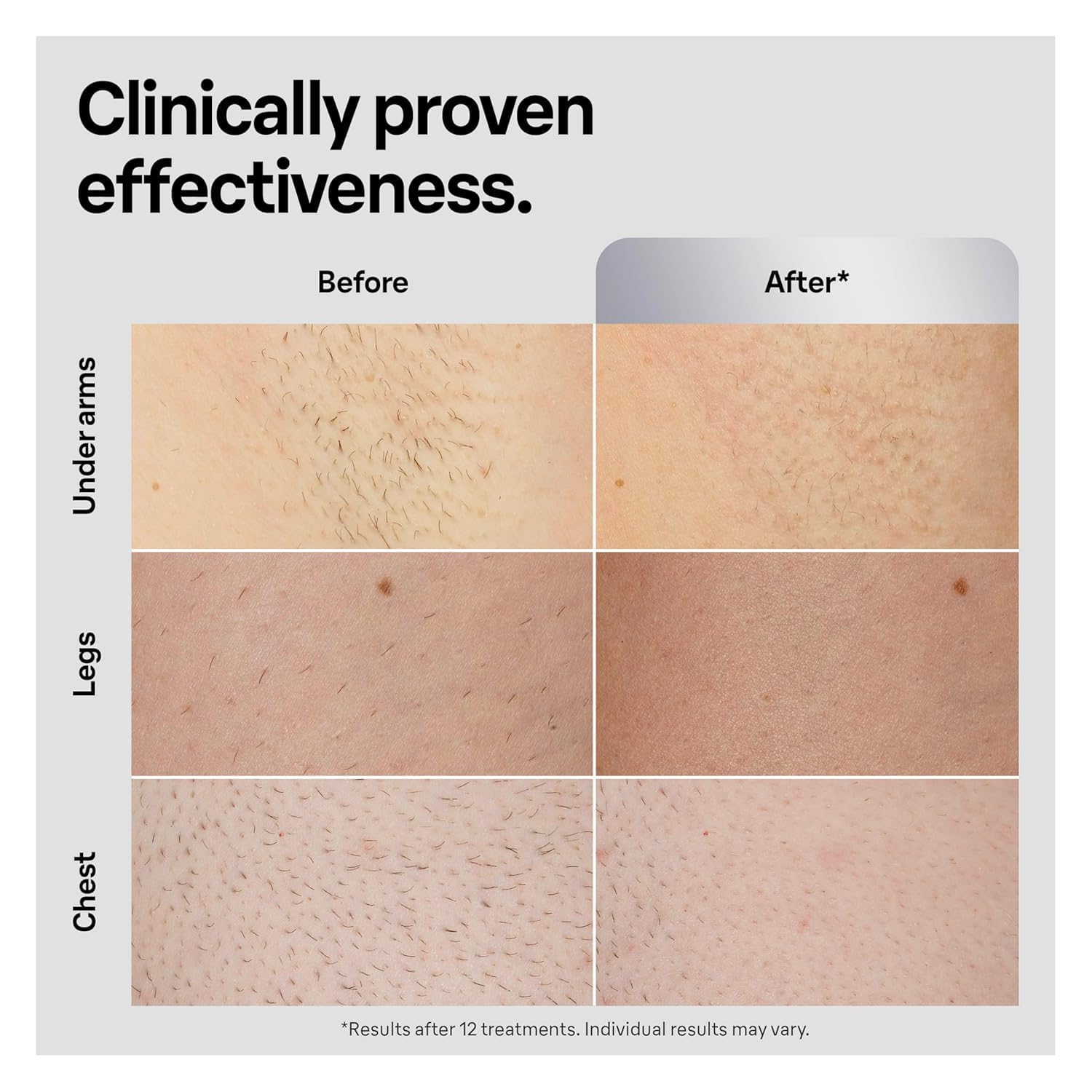 Braun IPL, Silk·Expert Pro 5, IPL Hair Removal for Women and Men, Permanent Laser Hair Reduction At-Home, 1 Head, IPL5100