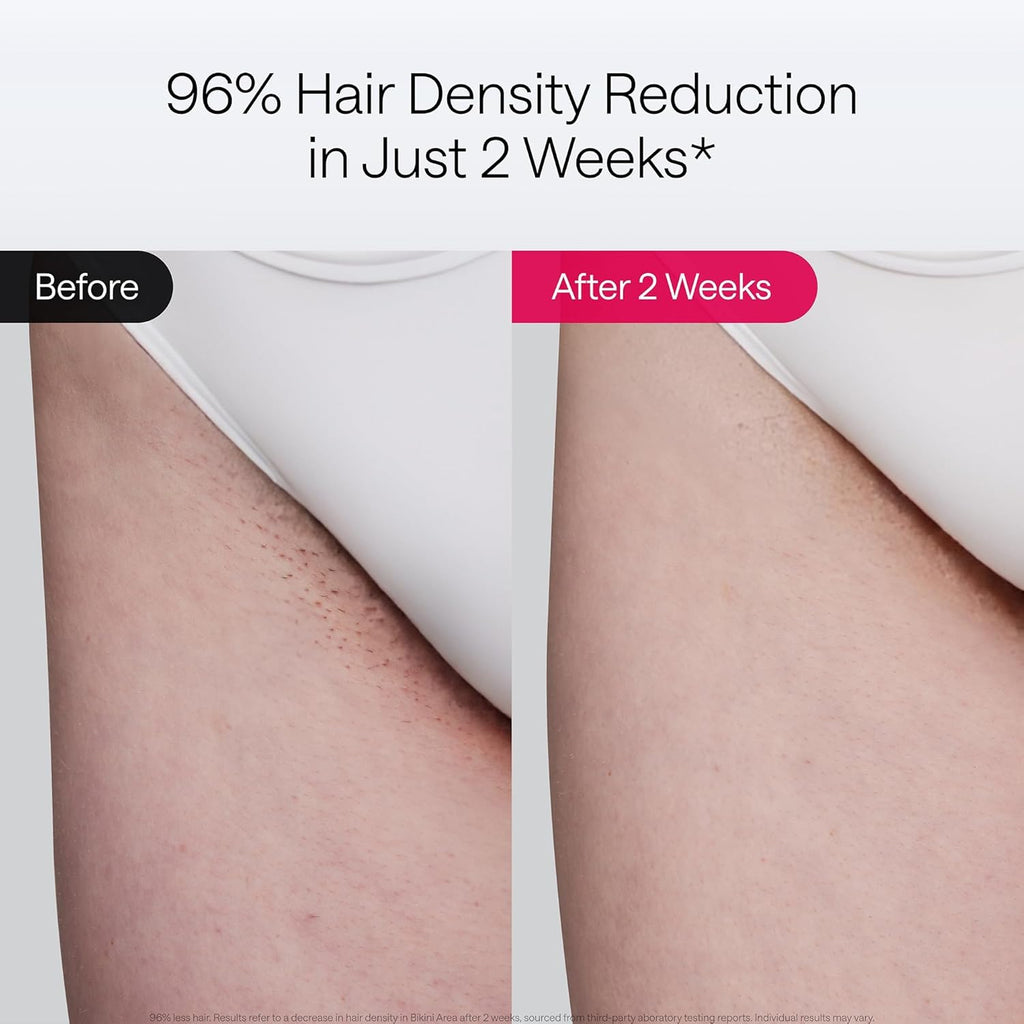 Ulike Laser Hair Removal Delux